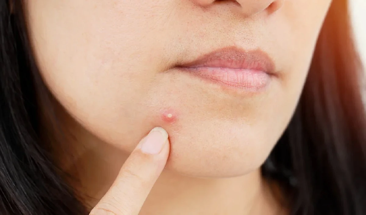 Acne Problem Solution: एक्सपर्ट्स से जानें मुंहासों से निजात पाने का तरीका, न करें इन 5 चीजों का सेवन